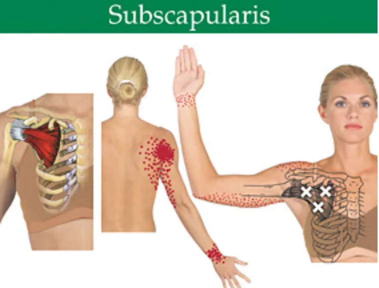 Subscapularis anatomy and referral pattern diagram