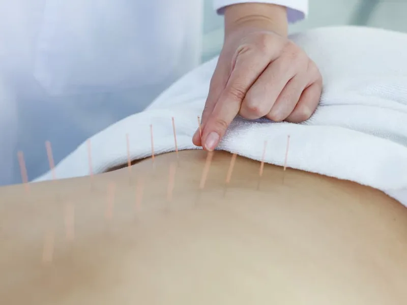 Acupuncture at Midtown East Physical Therapy in New York, NY